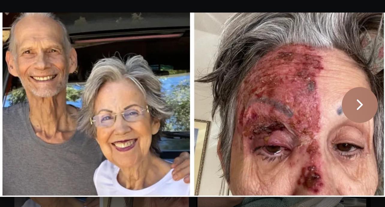 Shingles — before and after CD